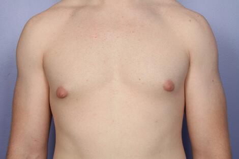 Breast Reduction (for Men) Before & After Image