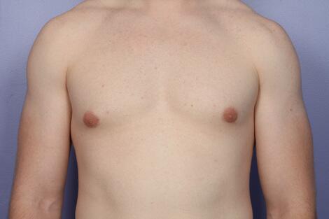 Breast Reduction (for Men) Before & After Image