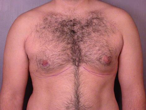 Breast Reduction (for Men) Before & After Image