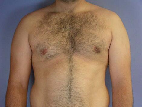 Breast Reduction (for Men) Before & After Image