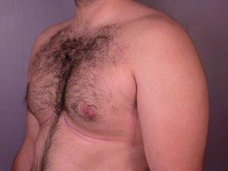 Breast Reduction (for Men) Before & After Image