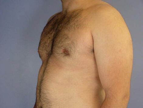 Breast Reduction (for Men) Before & After Image