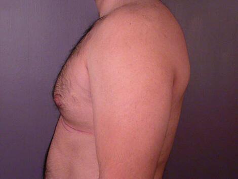 Breast Reduction (for Men) Before & After Image