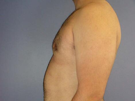 Breast Reduction (for Men) Before & After Image