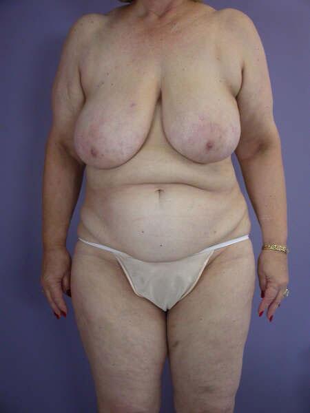 Breast Reduction (for Women) Before & After Image