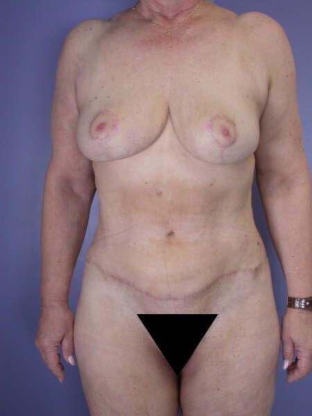 Breast Reduction (for Women) Before & After Image