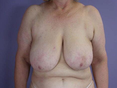 Breast Reduction (for Women) Before & After Image