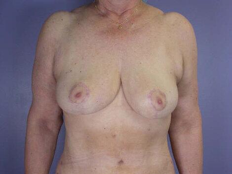 Breast Reduction (for Women) Before & After Image