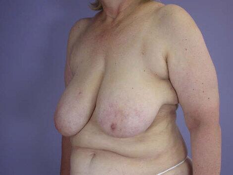 Breast Reduction (for Women) Before & After Image