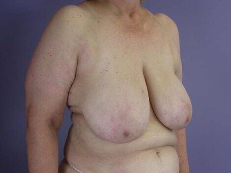 Breast Reduction (for Women) Before & After Image