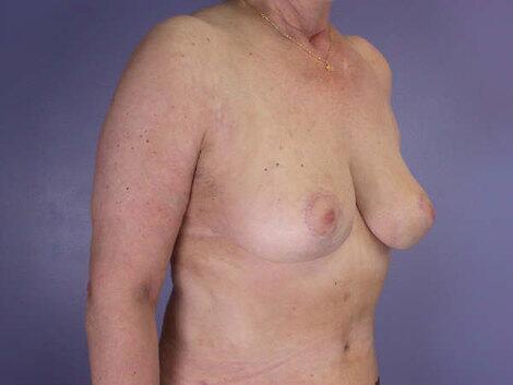 Breast Reduction (for Women) Before & After Image