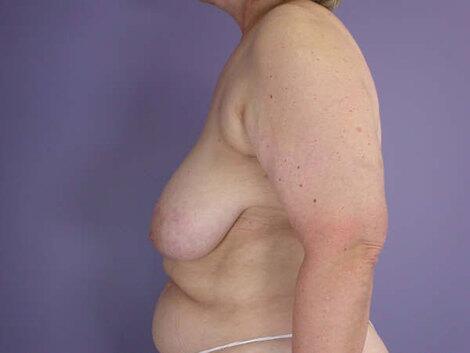 Breast Reduction (for Women) Before & After Image