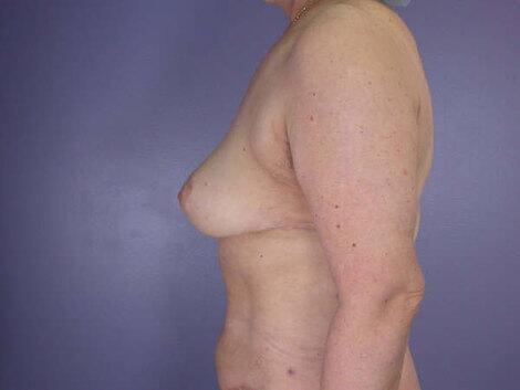 Breast Reduction (for Women) Before & After Image