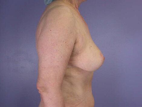 Breast Reduction (for Women) Before & After Image