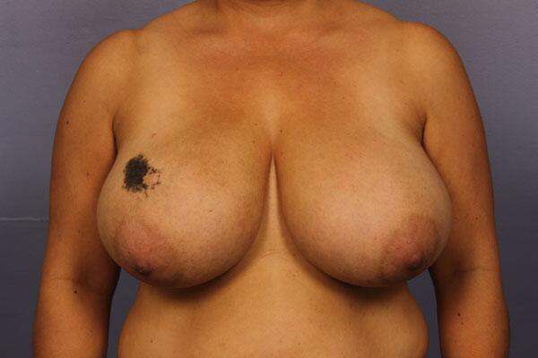 Breast Reduction (for Women) Before & After Image