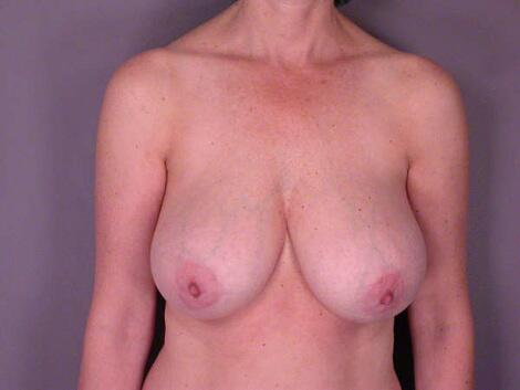 Breast Reduction (for Women) Before & After Image