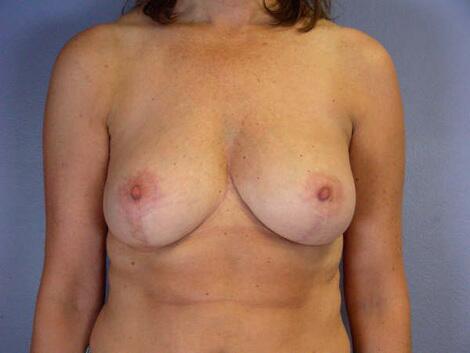 Breast Reduction (for Women) Before & After Image