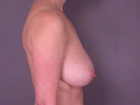 Breast Reduction (for Women) Before & After Image