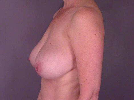 Breast Reduction (for Women) Before & After Image