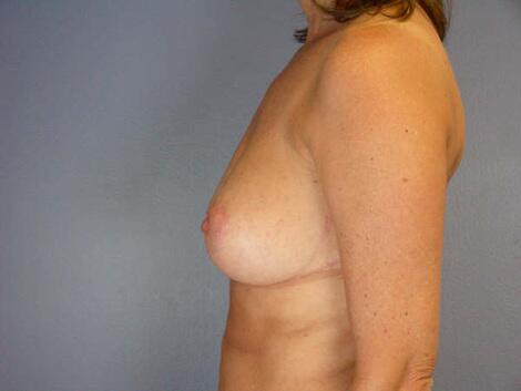 Breast Reduction (for Women) Before & After Image