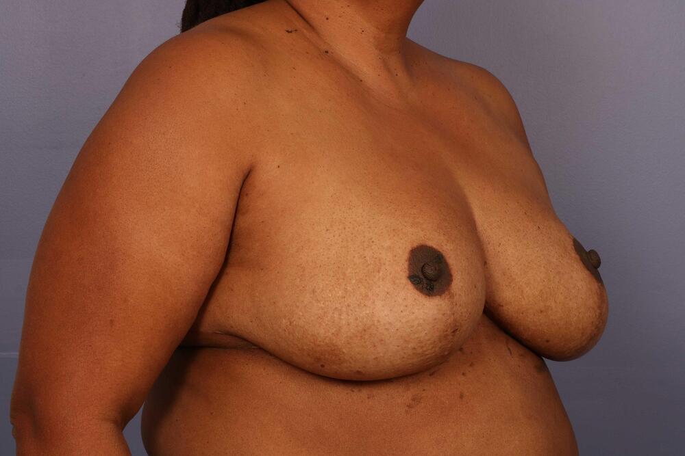 Breast Reduction (for Women) Before & After Image