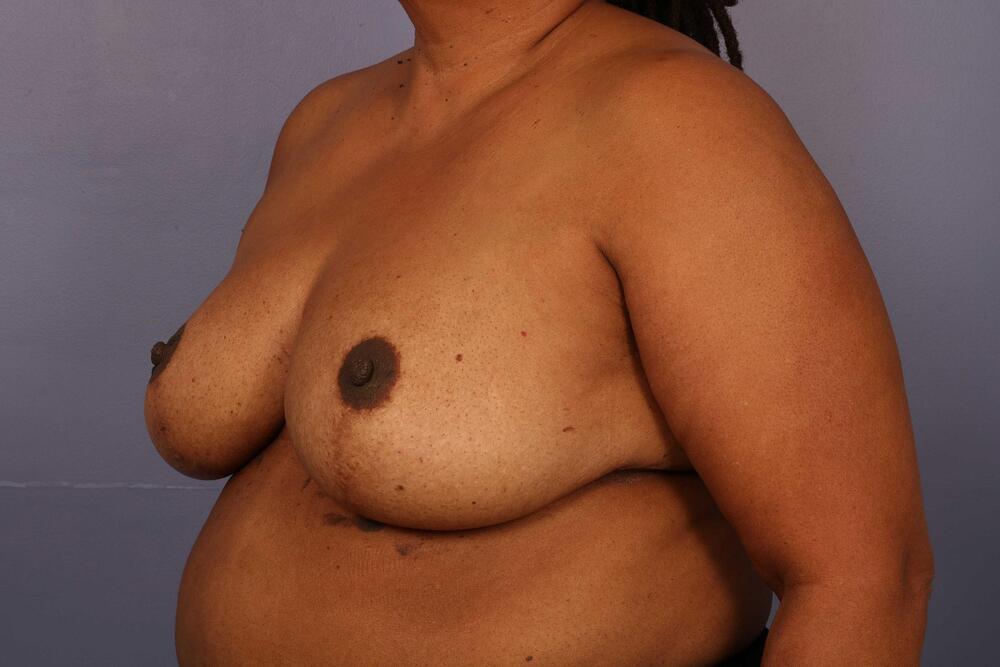 Breast Reduction (for Women) Before & After Image