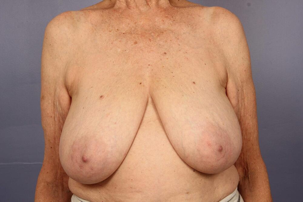 Breast Reduction (for Women) Before & After Image