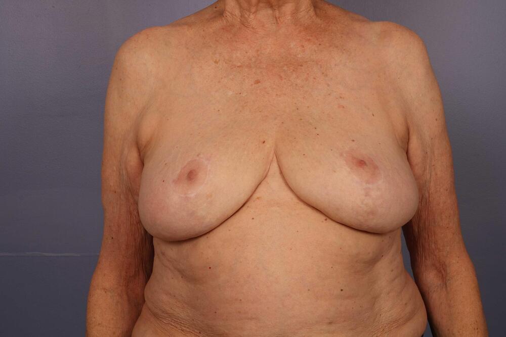 Breast Reduction (for Women) Before & After Image