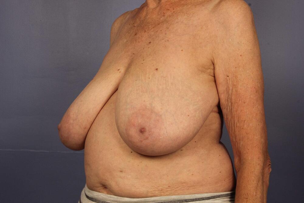 Breast Reduction (for Women) Before & After Image