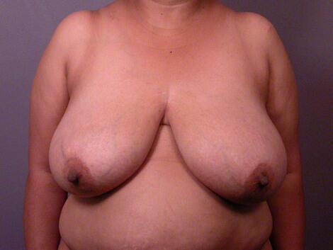 Breast Reduction (for Women) Before & After Image