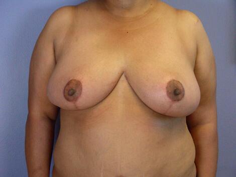 Breast Reduction (for Women) Before & After Image