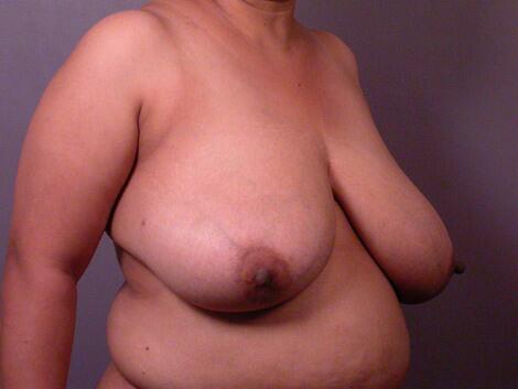 Breast Reduction (for Women) Before & After Image