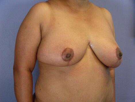 Breast Reduction (for Women) Before & After Image