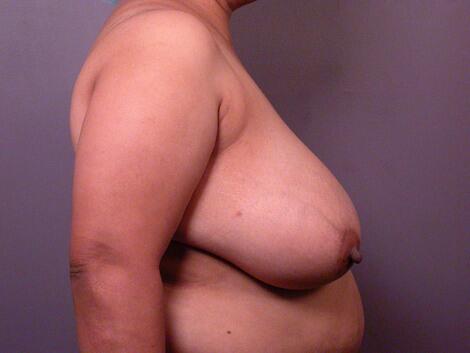 Breast Reduction (for Women) Before & After Image