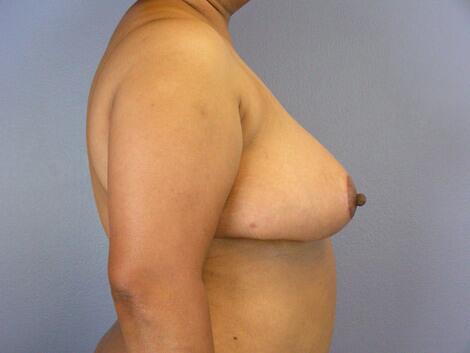 Breast Reduction (for Women) Before & After Image