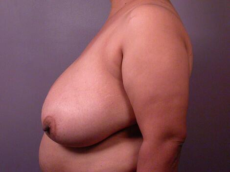 Breast Reduction (for Women) Before & After Image