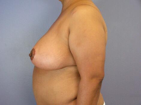 Breast Reduction (for Women) Before & After Image