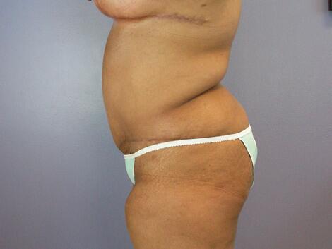 Breast Reduction (for Women) Before & After Image