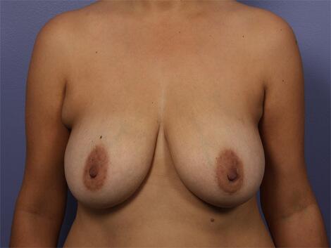 Breast Reduction (for Women) Before & After Image