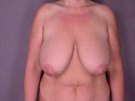 Breast Reduction (for Women) Before & After Image