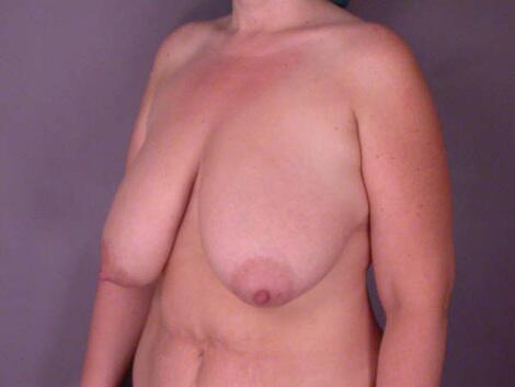 Breast Reduction (for Women) Before & After Image