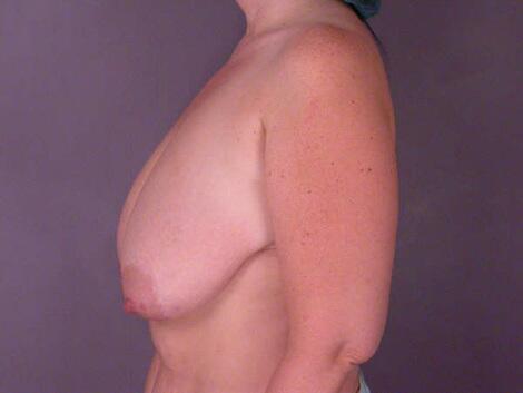 Breast Reduction (for Women) Before & After Image