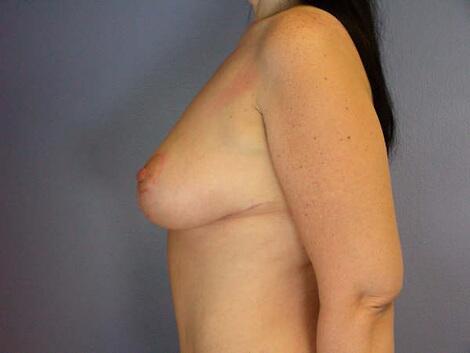 Breast Reduction (for Women) Before & After Image