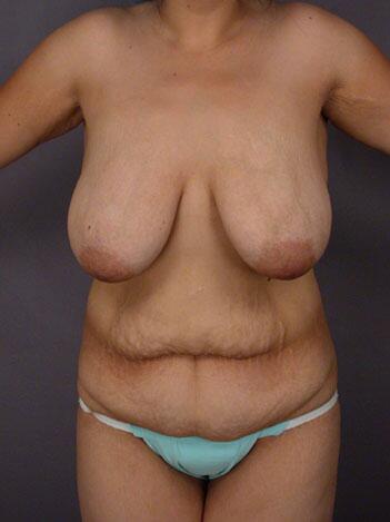 Breast Reduction (for Women) Before & After Image