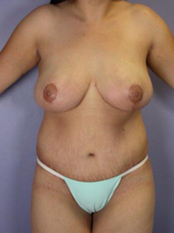 Breast Reduction (for Women) Before & After Image