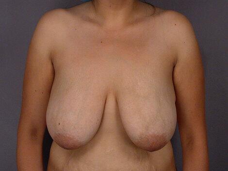 Breast Reduction (for Women) Before & After Image