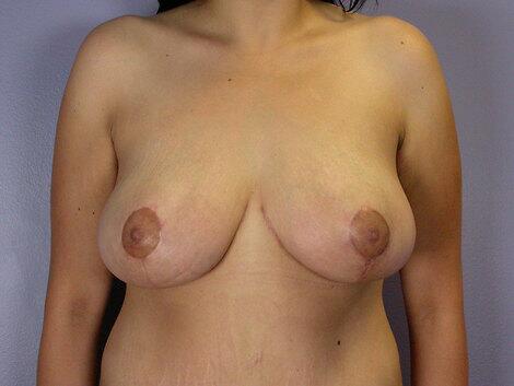 Breast Reduction (for Women) Before & After Image