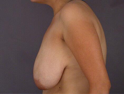 Breast Reduction (for Women) Before & After Image