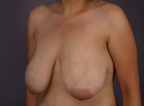 Breast Reduction (for Women) Before & After Image