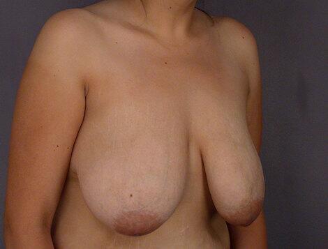 Breast Reduction (for Women) Before & After Image